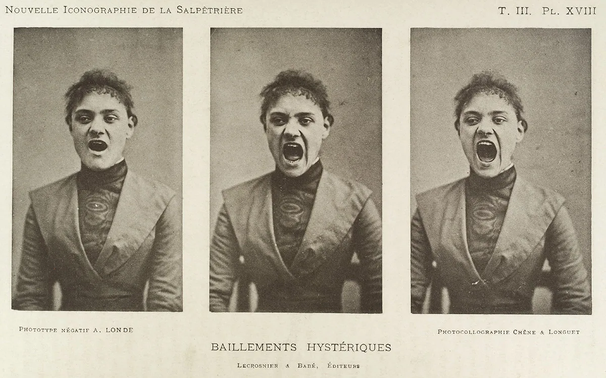 Diese Frau soll beim Gähnen Symptome von Hysterie zeigen. Bilder aus der Pariser Klinik Salpêtriere, eine der bekanntesten psychiatrischen Kliniken im 19. Jahrhundert.