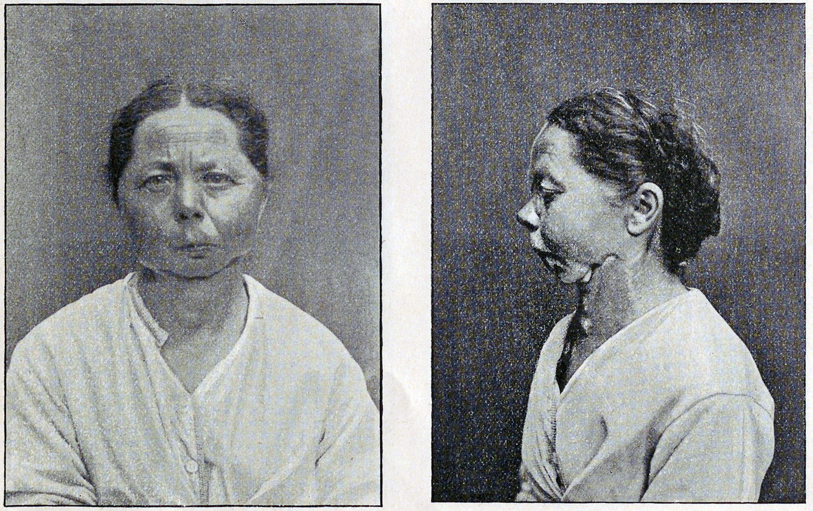 Der 1850 geborenen Margretha Trachsel aus Frutigen war wegen Nekrose der ganze Unterkiefer entfernt worden. Der Zeitpunkt der Operation ist nicht überliefert. Die Patientin kann nur zerkleinerte Speisen essen. Abbildung aus Theodor Kocher, «Zur Kenntnis der Phosphornekrose», 1893.