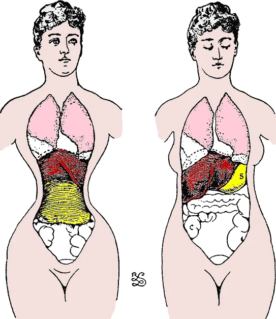 Die Medizin wies auf mögliche Organverlagerungen durch das Tragen eines Korsetts hin. Grafik aus dem Jahr 1887.